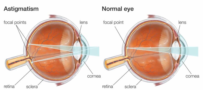 Graph showing astigmatism and normal eye